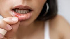 Primer plano de la boca de una persona con úlceras en la boca visibles en la mucosa oral